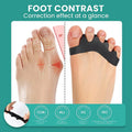 1 par de ortopédicos de dedo do pé de silicone macio, separadores de dedo do pé, ortopédicos de joanete e dedo do pé de martelo, adequados para corrida e prática de ioga